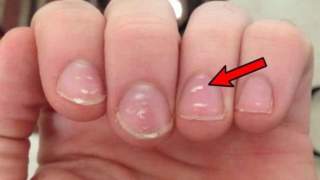 białe plamki na paznokciach