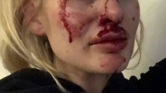 Brutalnie pobił i złamał ukochanej nos. Wytłumaczenie mężczyzny jest ABSURDALNE