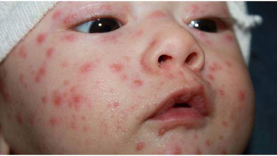 Epidemia odry uderzy w Polskę! W aptekach brakuje szczepionek, lekarze przerażeni