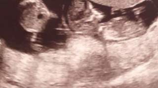 Kobieta zaszła w ciążę dwukrotnie w przeciągu 3 tygodni