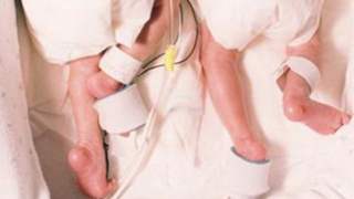 bliźniaczki zaczęła umierać