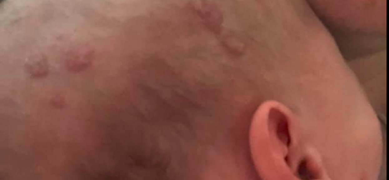 Z pozoru błahy strupek na skórze dziecka nie budził grozy. Gdy mama usłyszała diagnozę, aż zastygła