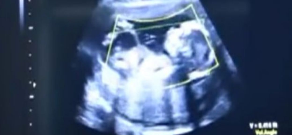 Przyszła mama poszła do lekarza dopiero w 41 tyg. ciąży. Lekarze zobaczyli jej USG i nie wierzyli własnym oczom