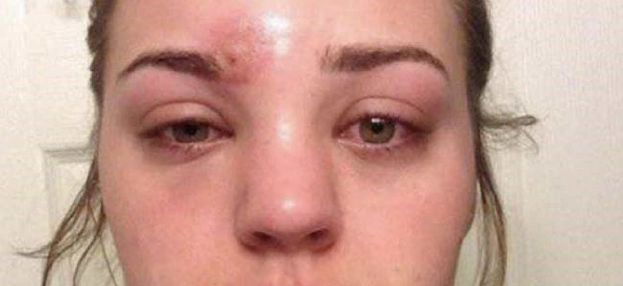 Nastolatka myślała, że wyciska pryszcza. Kilka godzin później lekarze walczyli o jej życie
