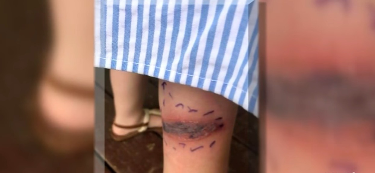 Mama zauważyła na kolanie córki dziwny siniak. Kiedy dowiedziała się, co to jest, rozpoczęła się walka o przeżycie
