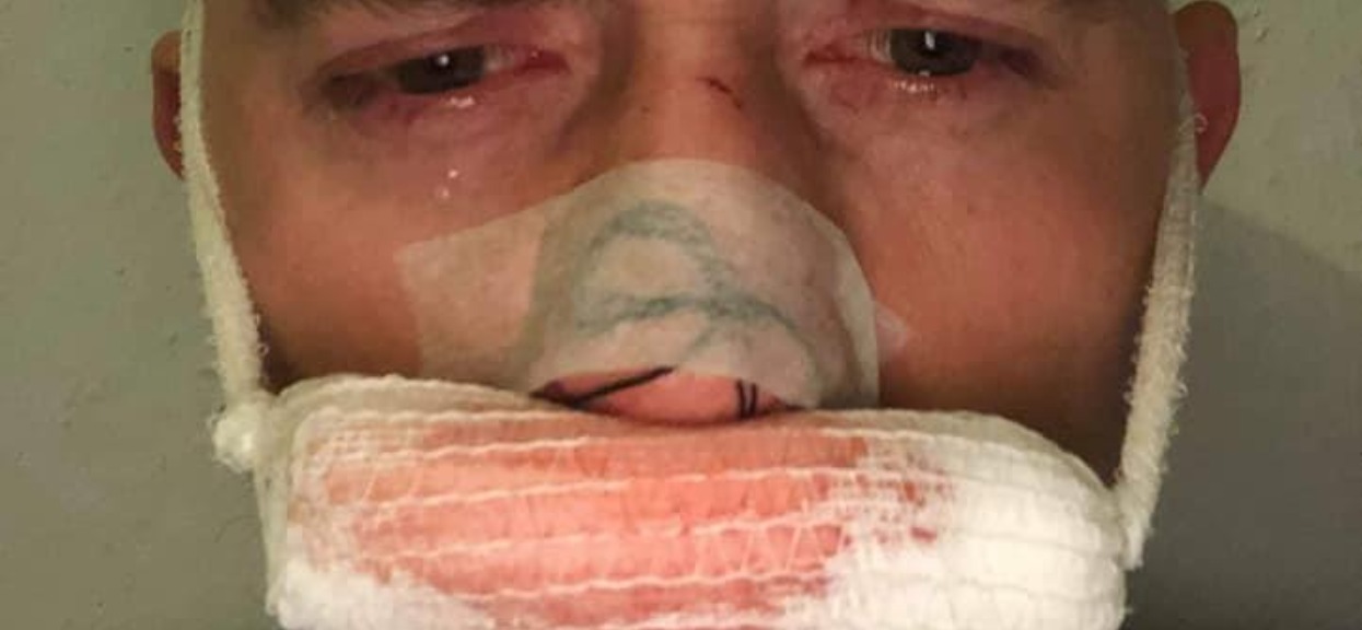 Młody aktor ma zmasakrowaną twarz. Miało dojść do brutalnego pobicia