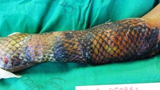 Ręka kobiety tygodniami była pokryta rybią łuską. Lekarze ją ściągnęli i ich oczom ukazał się oszałamiający widok