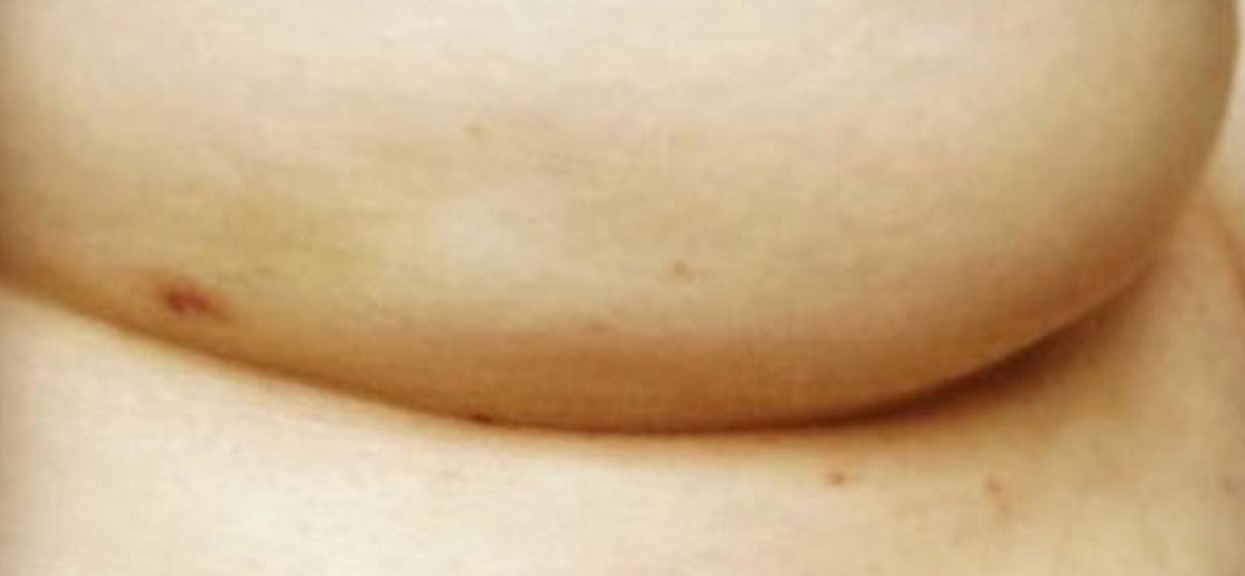 Zdjęcie pokazuje niepozorny objaw nowotworu. Mało kto o tym wie, a może uratować życie