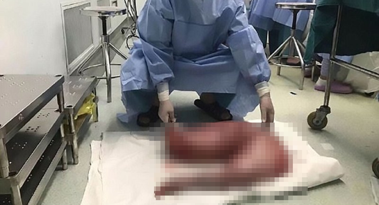 22-letni mężczyzna miał brzuch jak w ciąży z pięcioraczkami. Chirurdzy go rozcięli, i widząc, co miał w środku, oniemieli