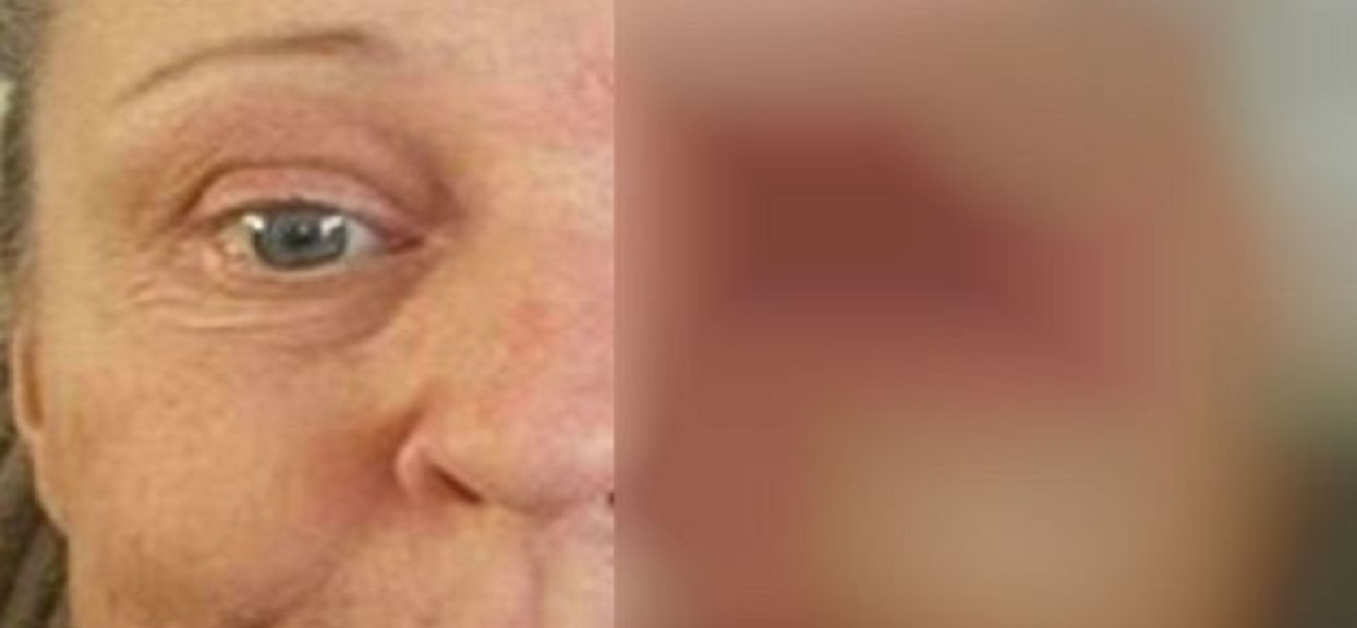 Uderzyła się o piekarnik i miała drobną rankę. 24 godziny później stoczyli dramatyczną walkę o jej twarz