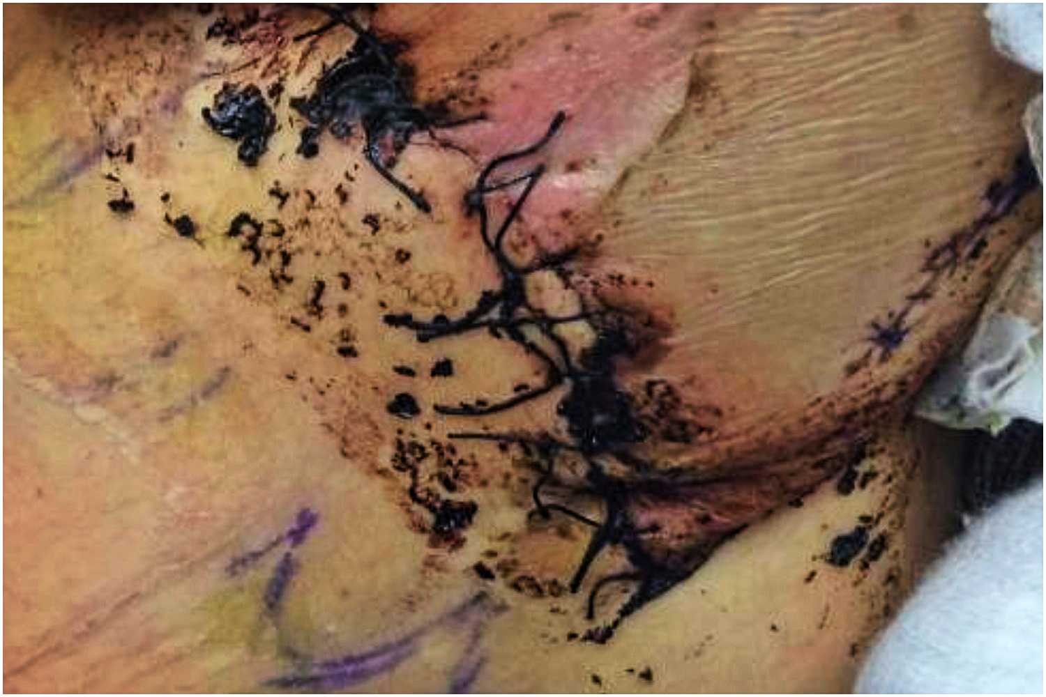 Lekarze zaszyli mu rękę w brzuchu. Zdecydował się pokazać drastyczne zdjęcia (foto 18+)