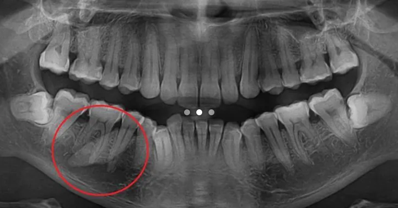 Bolał go trochę ząb. Dentysta zrobił rentgen i zaniemówił
