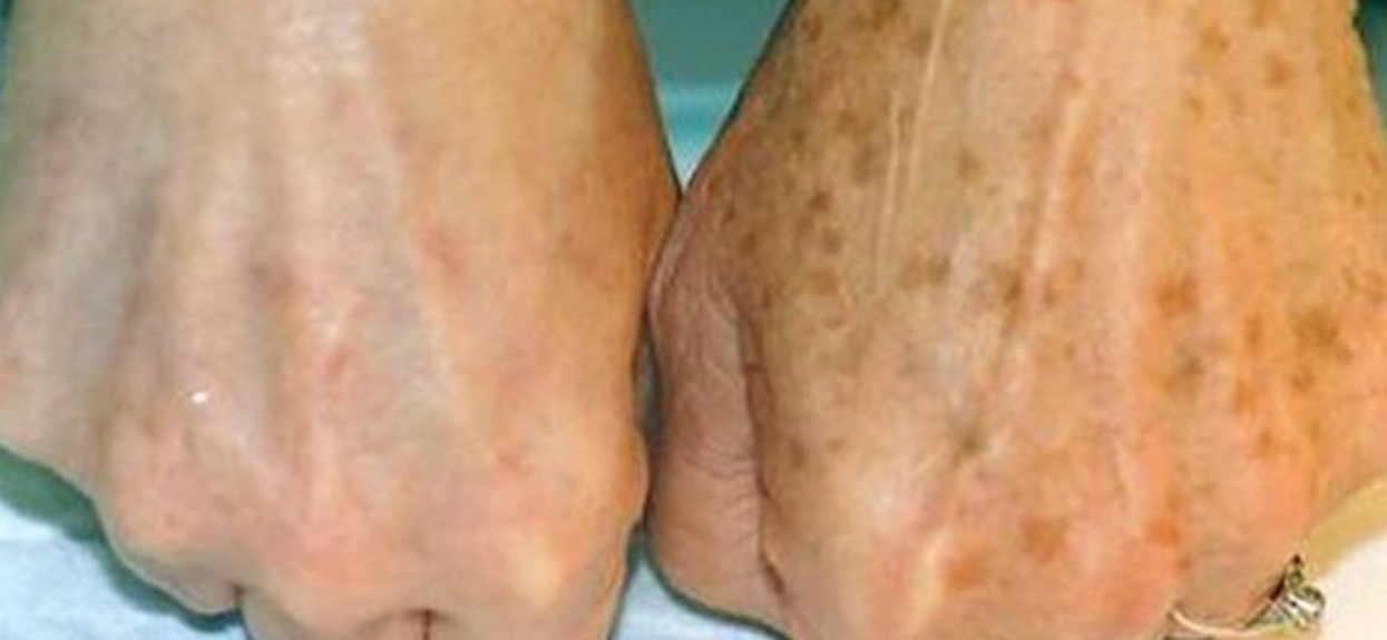 Fenomenalny domowy trik dermatologa na usunięcie brązowych plamek z dłoni i twarzy. Wystarczą 2 składniki, tanie jak barszcz