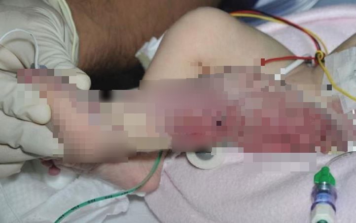 Tuż po porodzie lekarze zobaczyli dziecko i zamarli z przerażenia. Mama pobladła, a zobaczyła tylko nóżkę