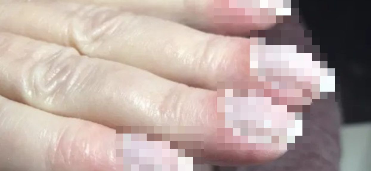 Kosmetyczka spojrzała na jej paznokcie i uratowała jej życie. Zobaczyła rzadki objaw raka, wygląda bardzo niepozornie
