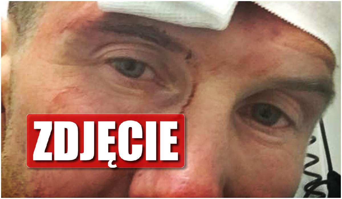 Polski muzyk miał wypadek. Jego twarz wygląda okropnie