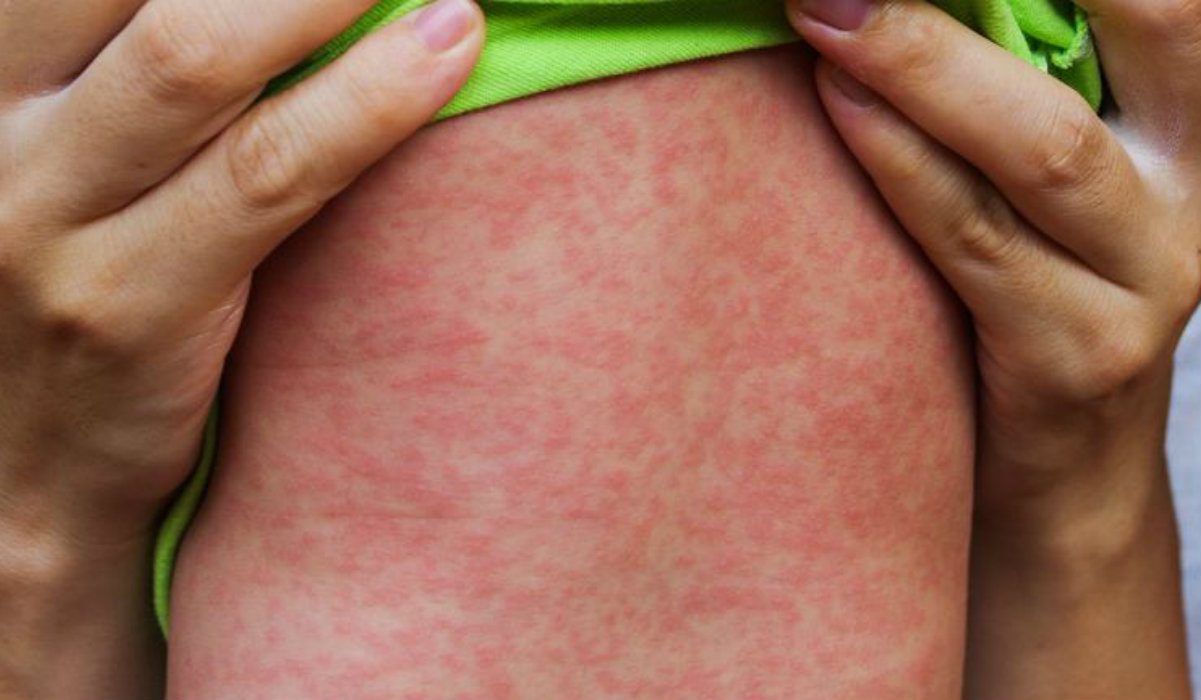 Antyszczepionkowa patologia wygrała. Odra wróciła do Polski, grozi nam epidemia