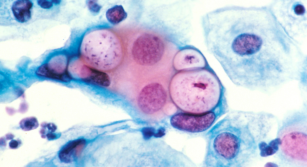 70% nie wie, że na to choruje! Chlamydia zbiera żniwo