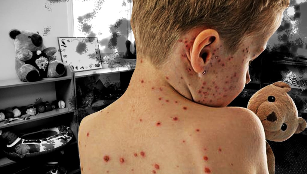 Epidemia zakaźnej choroby szaleje w polskich przedszkolach. Jej objawy wydają się niegroźne