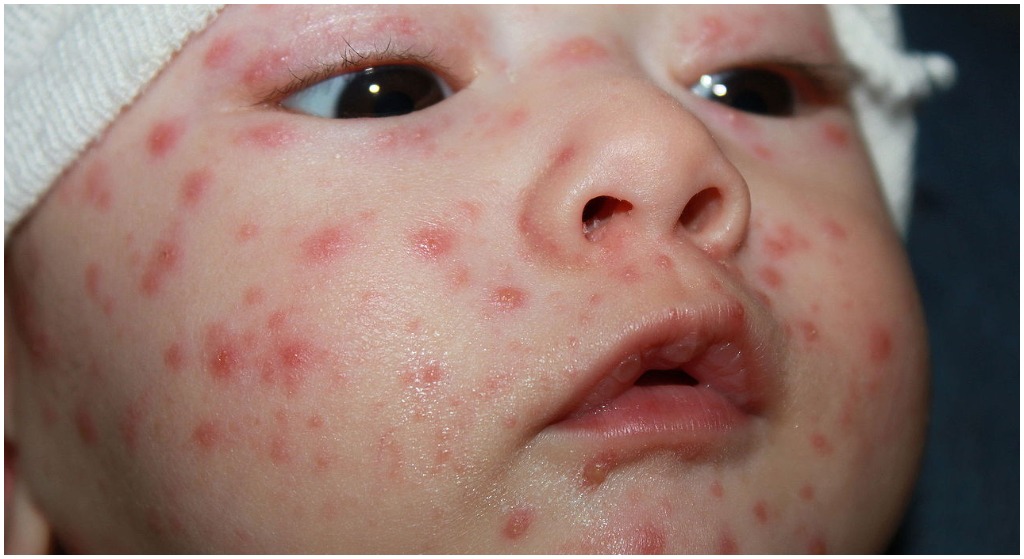 Epidemia odry uderzy w Polskę! W aptekach brakuje szczepionek, lekarze przerażeni