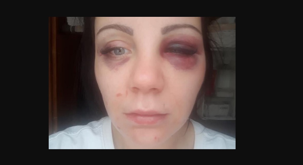 Kobieta pokazała twarz po pobiciu przez męża. Jednak nie to jest najbardziej przerażające