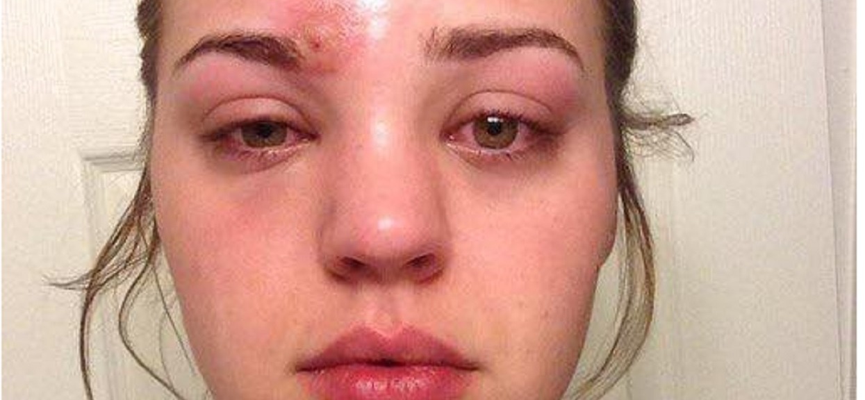 21-latka omal nie straciła życia. Wszystko przez makijaż