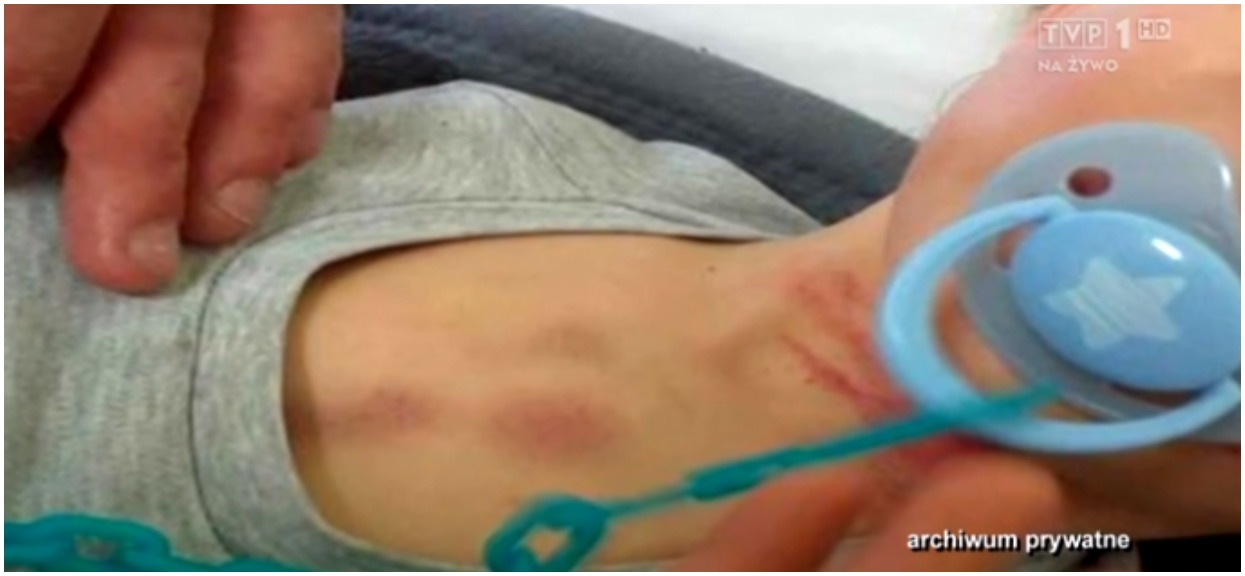 Konkubent matki brutalnie skatował Szymona. TVP informuje o tragedii 2-letniego dziecka