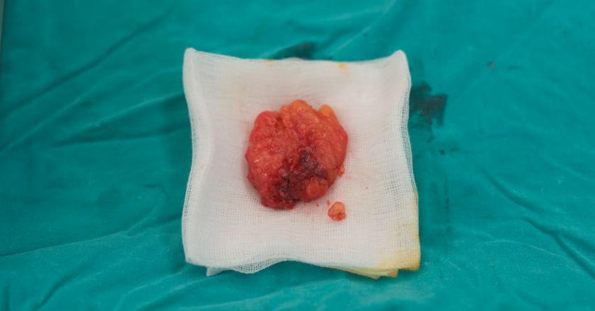 Nowotwór niezłośliwy lipoma