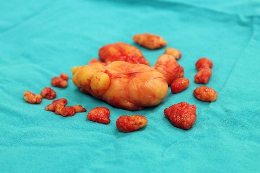 Nowotwór niezłośliwy lipoma