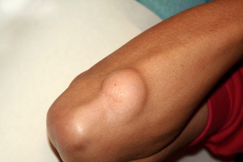 Nowotwór niezłośliwy lipoma